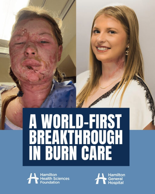 A world-first is happening right here in south-central Ontario 🌍 

Our Hamilton Health Sciences burn experts are the first in the world to use exosome therapy on a burn patient — and the results are remarkable. Exosomes are tiny cell-derived particles that speed up healing and tissue repair. When 18-year-old Kaitlin Jeffrey was severely burned in a house fire, this groundbreaking treatment helped her avoid devastating skin graft surgery to her face and neck. Led by Dr. Marc Jeschke and approved for compassionate use by Health Canada, the treatment helped Kaitlin heal faster and with better results than ever thought possible. 

"It's honestly a miracle," Kaitlin says. 

This is more than one young woman's recovery. It's a glimpse of the future. A future where exosome therapy could become the new standard of care for burn patients in Canada and beyond. We're proud to support the people and research making moments like this possible. 

Read Kaitlin's full story through the link in our bio. 

#BurnCare #MedicalInnovation #WorldFirst #HamiltonHealthSciences